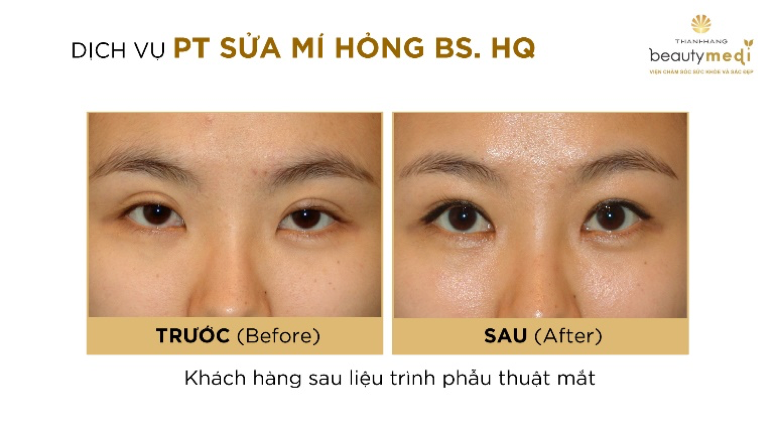 Hình ảnh thực tế khách hàng trước và sau khi phẫu thuật thẩm mỹ mắt tại Thanh Hằng Beauty Medi