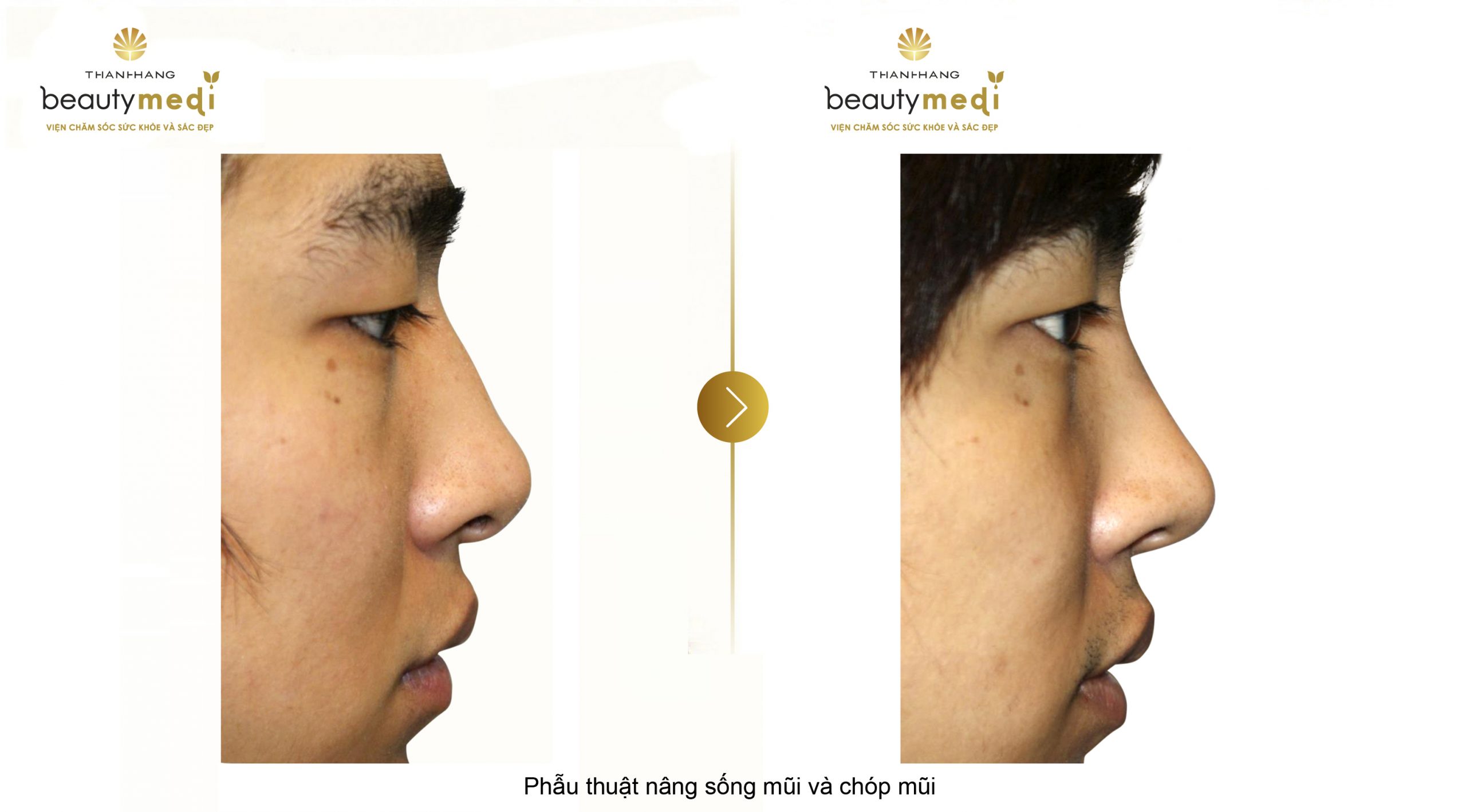 Hình ảnh trước và sau phẫu thuật nâng sống và chóp mũi