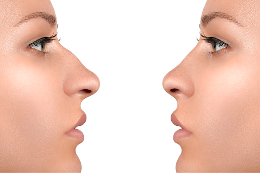 Tìm hiểu về mũi gồ và phương pháp phẫu thuật chỉnh hình lấy lại dáng mũi đẹp tự nhiên