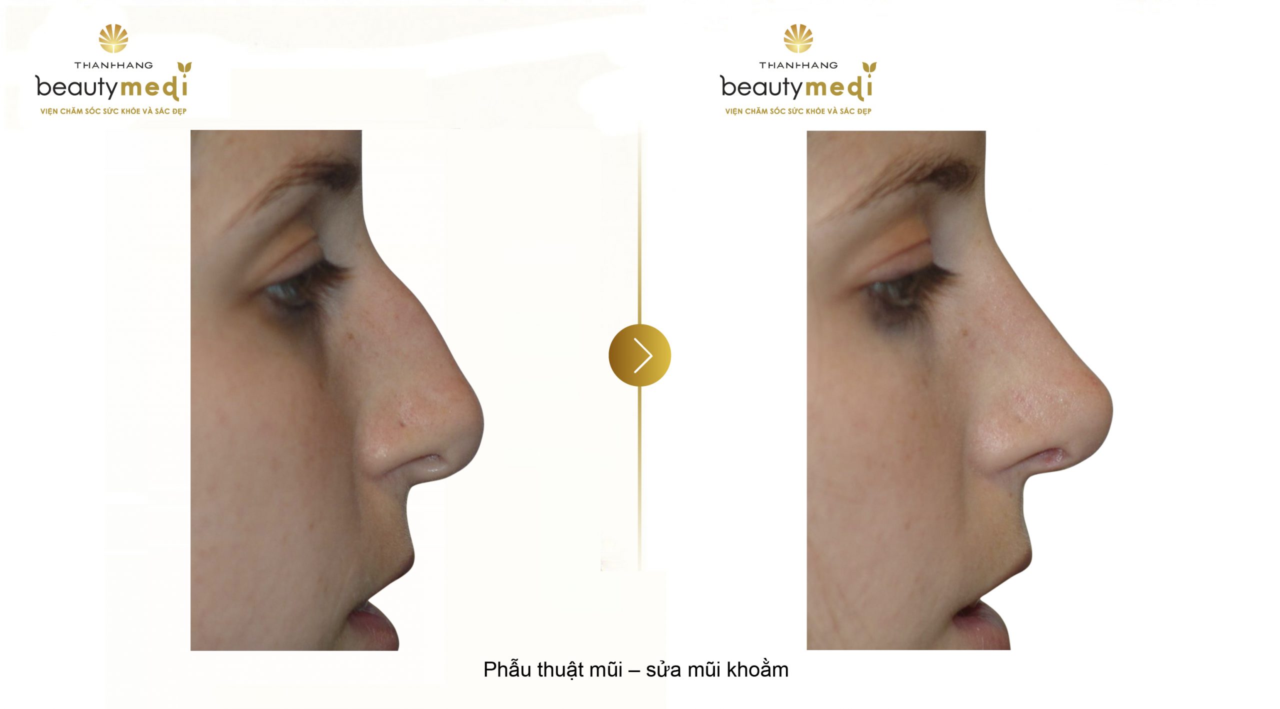 Hình ảnh trước và sau khi phẫu thuật mũi gồ ghề, mũi khoằm