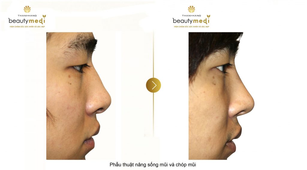 Hình ảnh khách hàng trước và sau phẫu thuật nâng mũi 