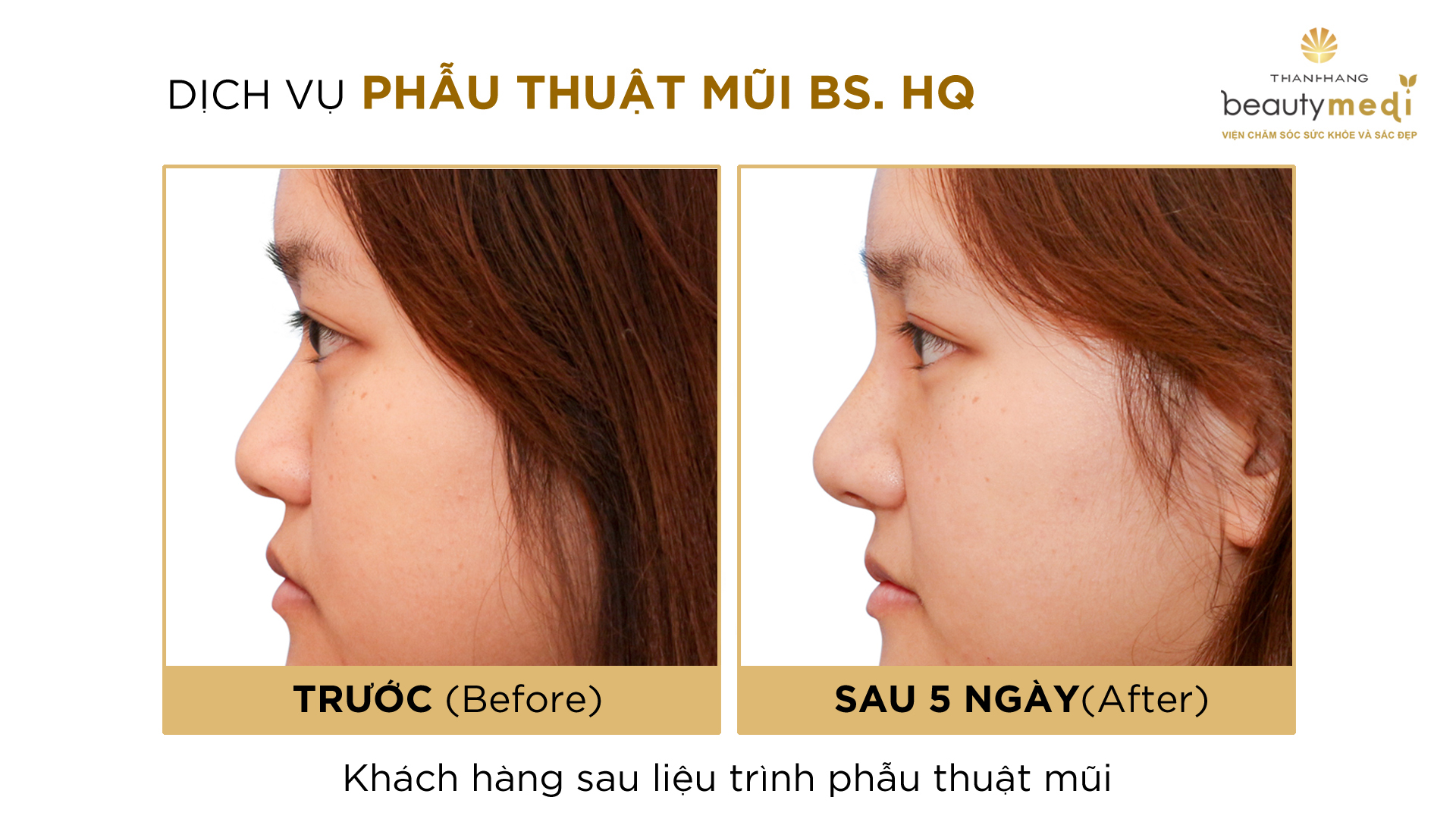 Hình ảnh khách hàng trước và sau phẫu thuật nâng mũi 