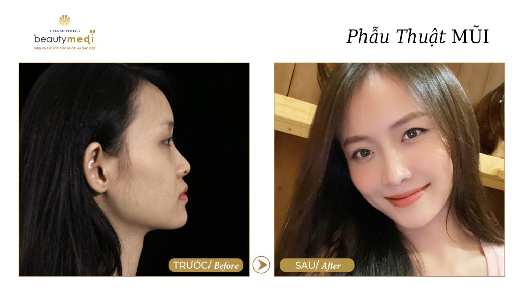 Hình ảnh trước và sau khi phẫu thuật nâng mũi của khách hàng tại Thanh Hằng Beauty Medi
