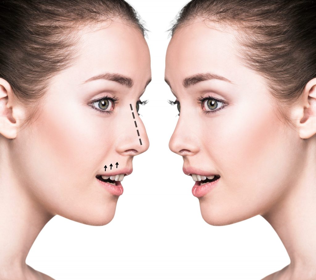 Hiệu quả thẩm mỹ sau nâng mũi tự thân có thể duy trì vĩnh viễn
