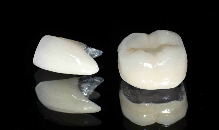 Bọc răng sứ kim loại có nhiều ưu điểm, phù hợp đa số đối tượng