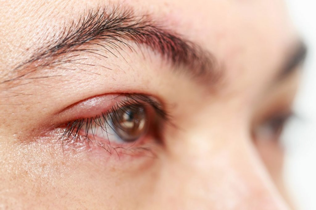 Nhấn mí mắt có thể để lại sẹo nếu bác sĩ không có chuyên môn khâu thẩm mỹ
