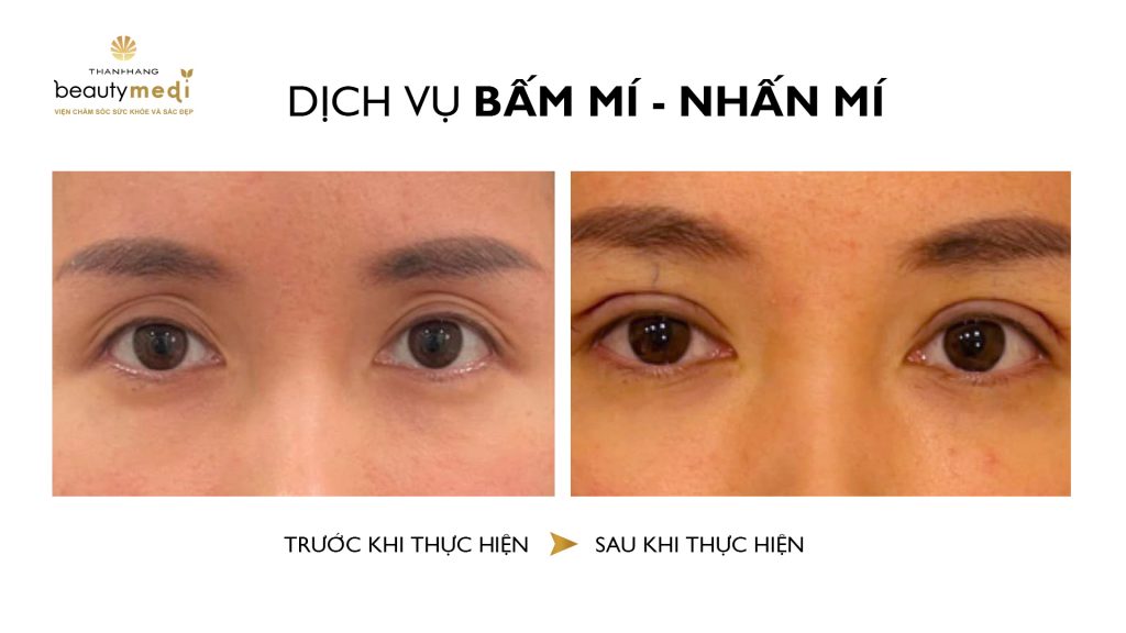 Hình ảnh trước và sau khi nhấn mí tại Thanh Hằng Beauty Medi 