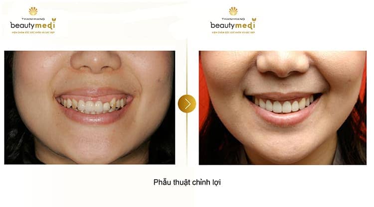 Phẫu thuật chỉnh lợi an toàn