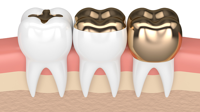 Răng sứ kim loại đá quý có khả năng sát khuẩn cao và không gây kích ứng khoang miệng
