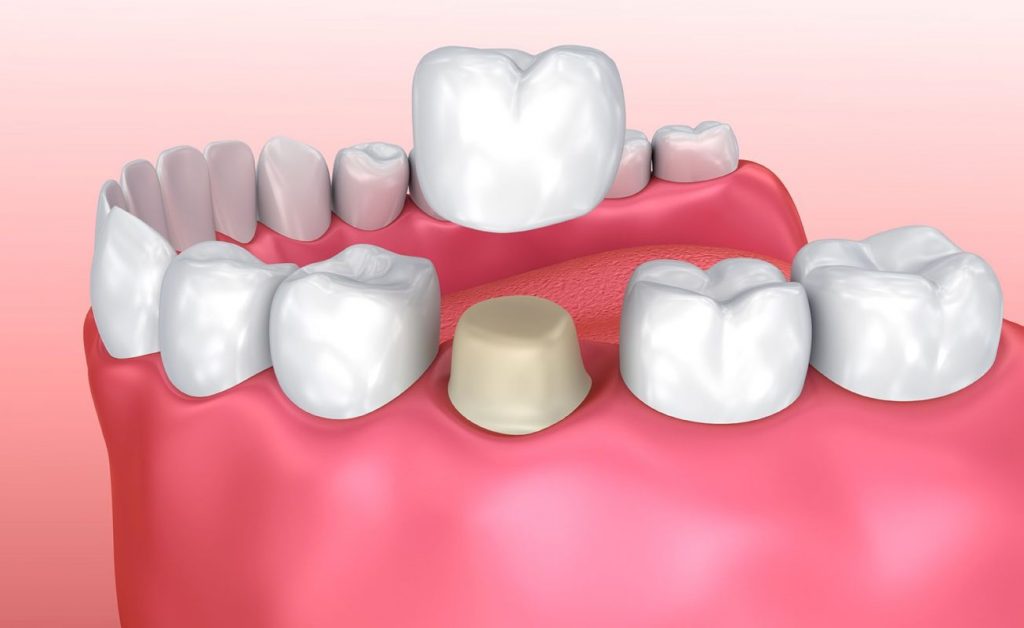 Bọc răng sứ thẩm mỹ là gì