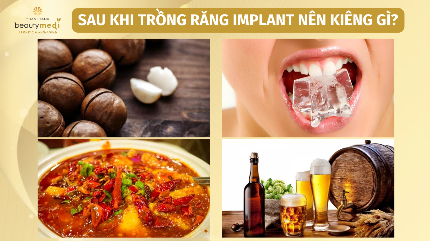 kiêng ăn gì sau khi trồng răng implant