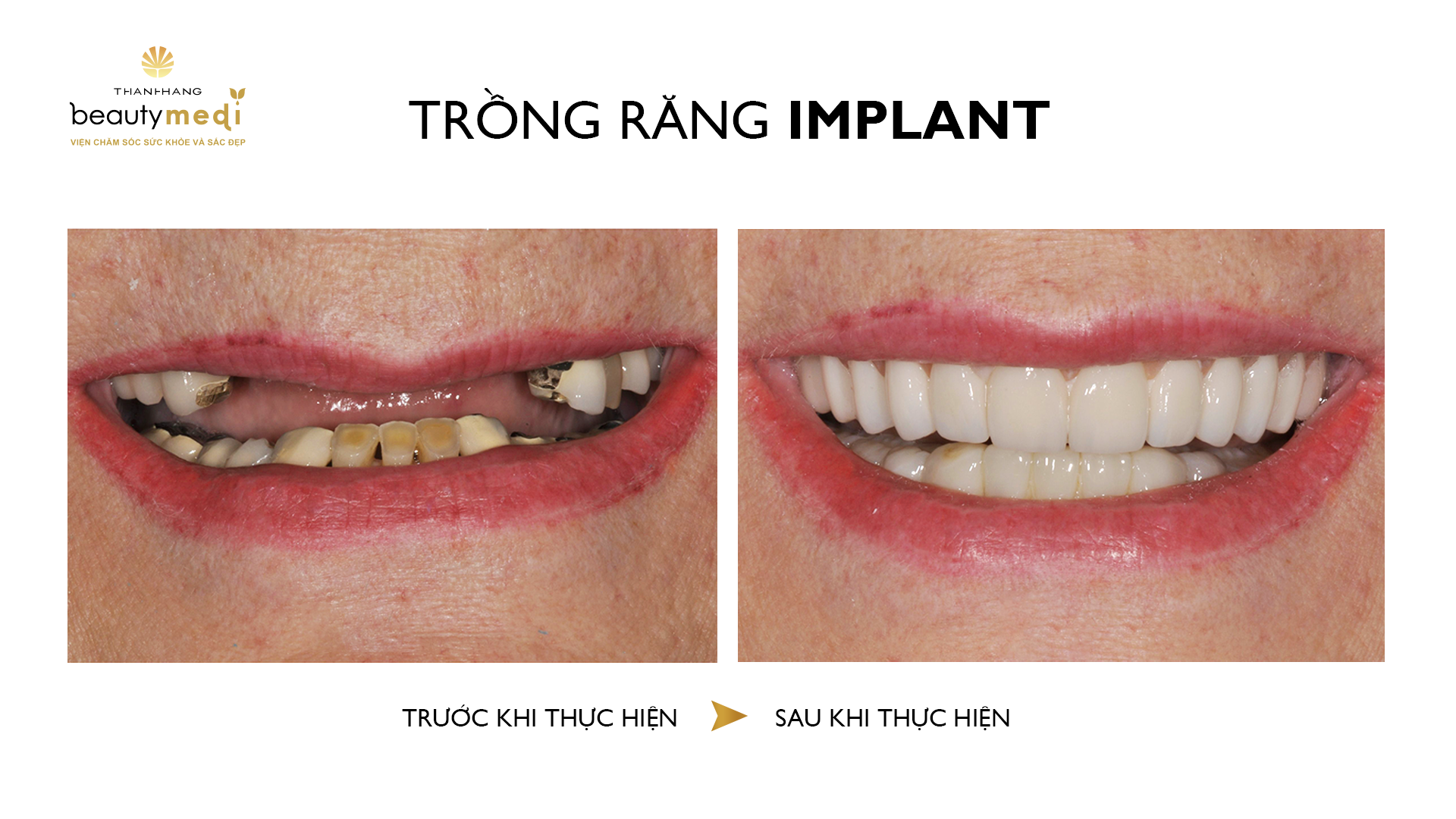 Trồng răng implant tại Thanh Hằng Beauty Medi được thực hiện vô cùng chuẩn chỉnh