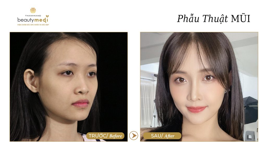 Hình ảnh trước và sau khi phẫu thuật mũi của khách hàng tại Thanh Hằng Beauty Medi