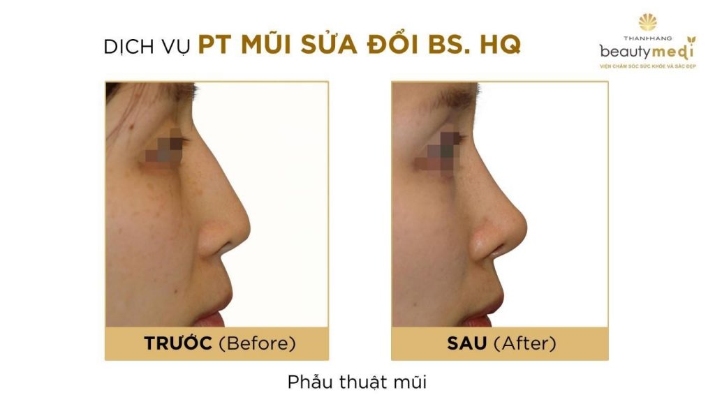 Hình ảnh khách hàng sửa mũi tự nhiên tại Thanh Hằng Beauty Medi