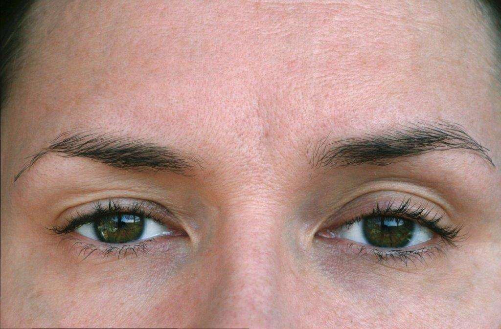 Sụp mí mắt 1 bên có thể xuất phát từ nhiều nguyên nhân khác nhau
