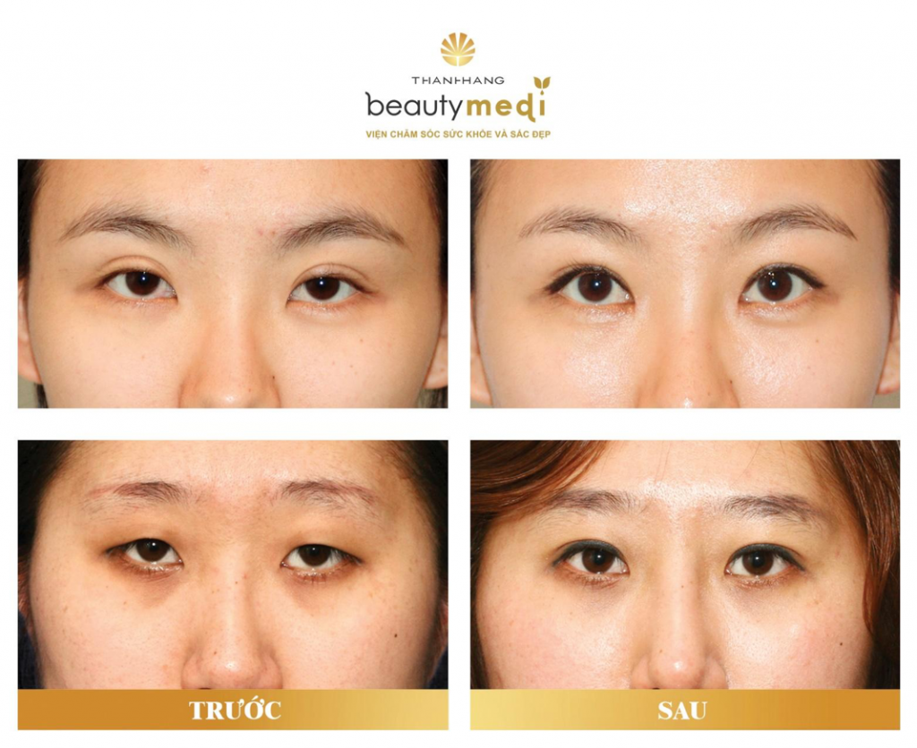 Hình ảnh khách hàng sử dụng dịch vụ phẫu thuật thẩm mỹ mắt tại Thanh Hằng Beauty Medi