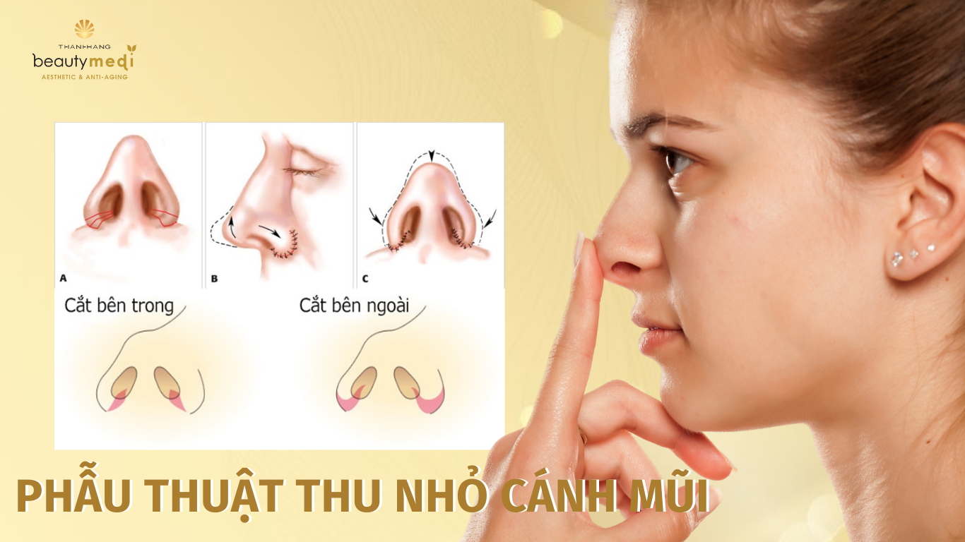 thu gọn cánh mũi giá bao nhiêu