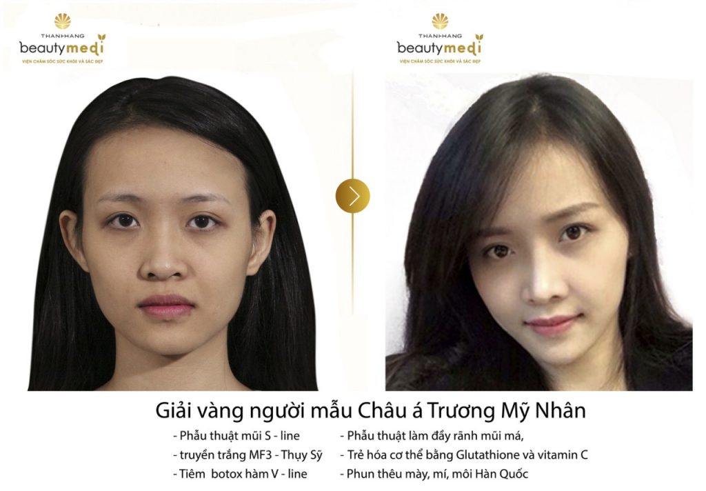 Hình trước và sau khi phẫu thuật thu gọn cánh mũi tại Thanh Hằng Beauty Medi