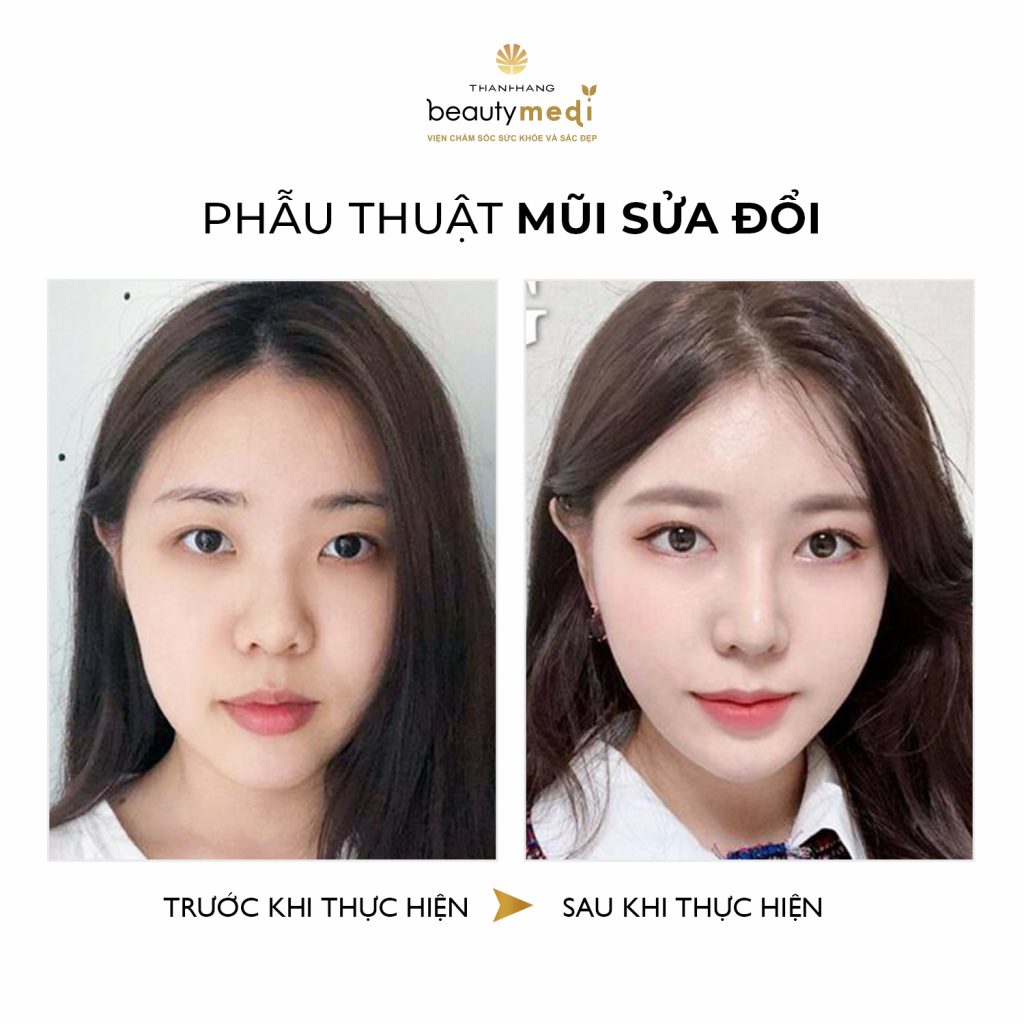 Thay đổi sau khi phẫu thuật thu nhỏ cánh mũi