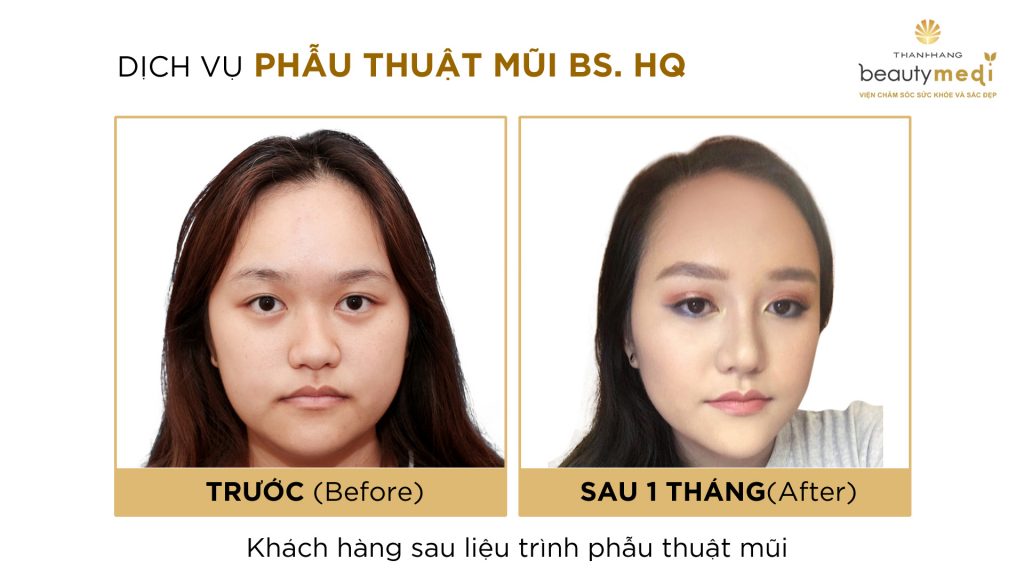 Hình ảnh trước và sau khi sử dụng dịch vụ thẩm mỹ mũi và thu nhỏ đầu mũ