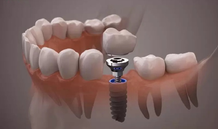 “Trồng răng Implant có đau không?” nhận được sự quan tâm lớn của nhiều người