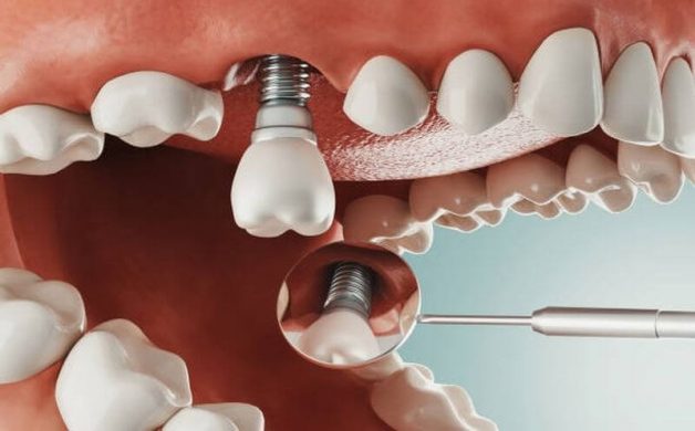 Có nhiều lý do khiến khách hàng bị đau và sưng sau khi trồng răng Implant