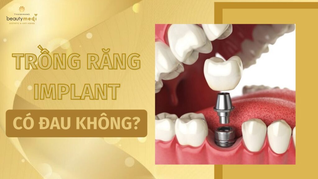 trồng răng implant có đau không