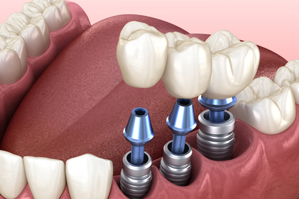 Trồng răng Implant giá bao nhiêu? Lựa chọn cách thức trồng răng Implant phù hợp và chất lượng để tiết kiệm chi phí