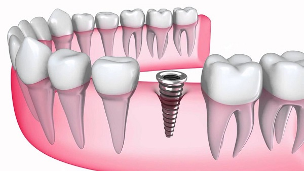 Chọn địa điểm trồng răng Implant phù hợp với nhu cầu cũng là cách tiết kiệm chi phí