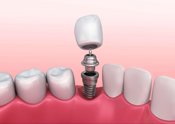 Các bạn nên sử dụng dịch vụ làm răng Implant trọn gói