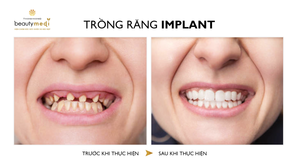 Hình ảnh trước và sau của khách hàng sau khi trồng răng Implant tại Thanh Hằng Beauty Medi 