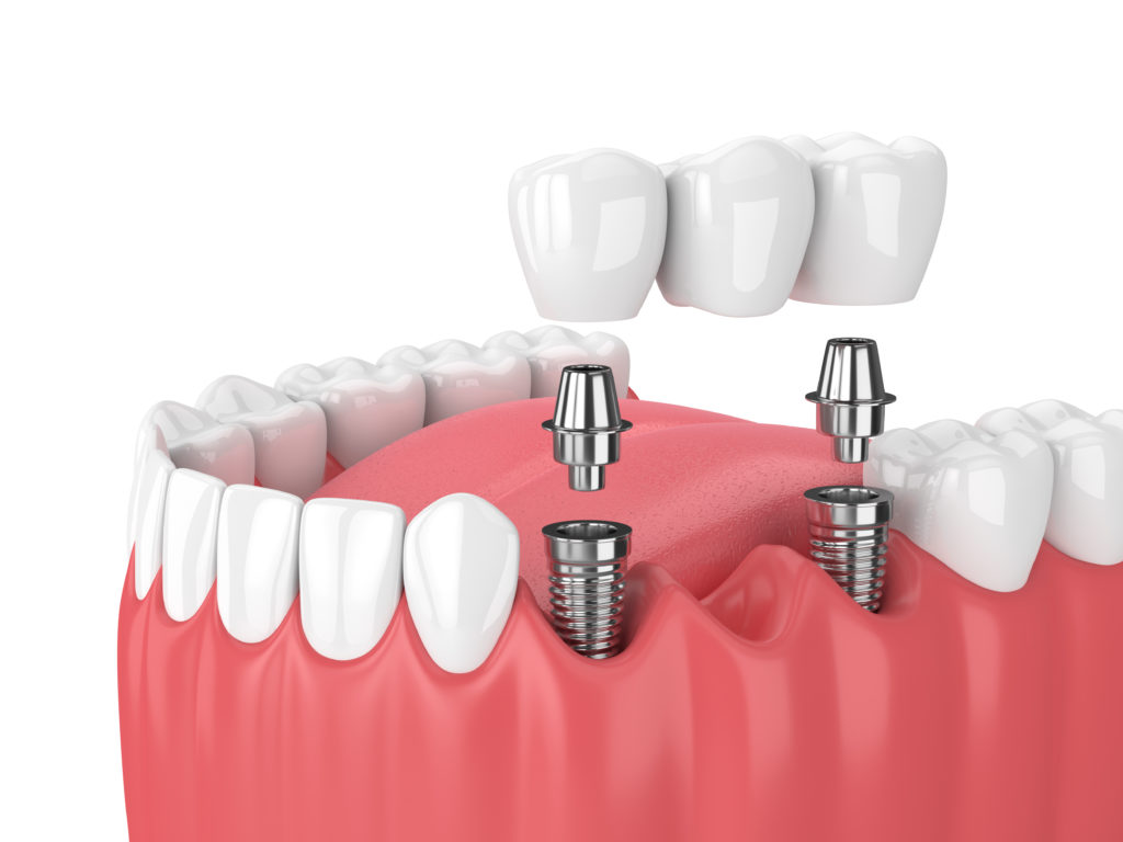 Cấy ghép Implant là phương pháp được sử dụng để thay thế răng bị mất