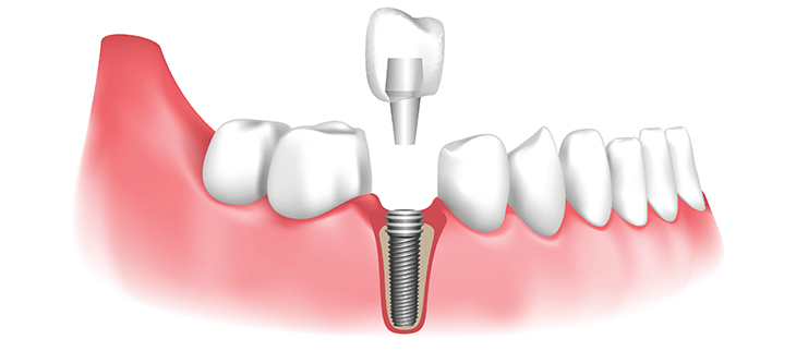 Giai đoạn phẫu thuật đặt trụ Implant