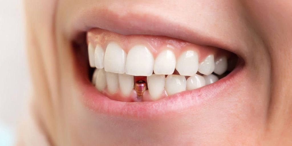 Tình trạng răng miệng ảnh hưởng đến thời gian trồng Implant