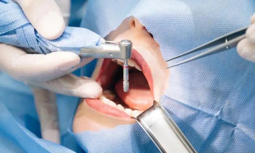 Tay nghề bác sĩ quyết định thời gian cấy ghép Implant 