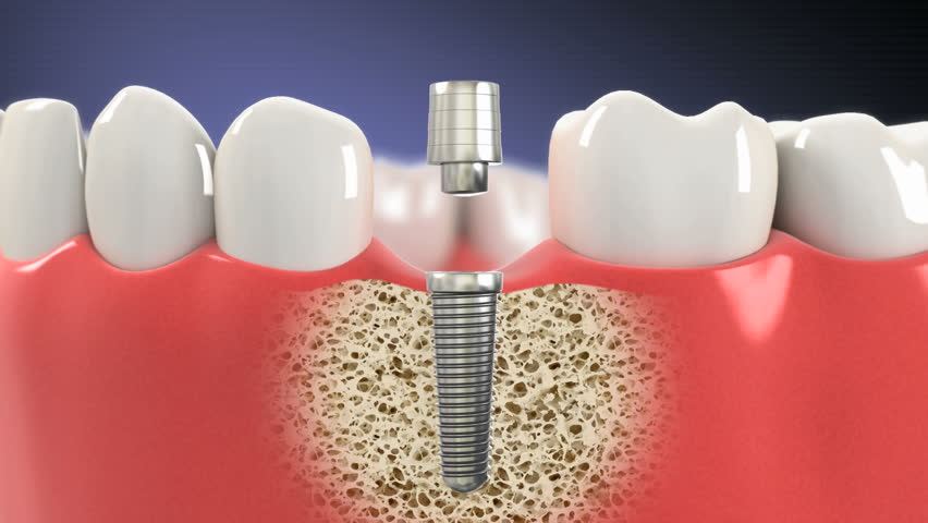 Cắm trụ Implant sau khi nhổ răng