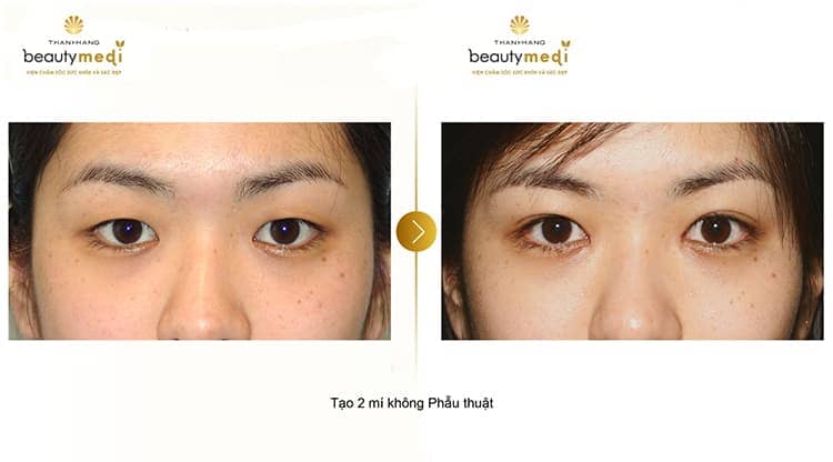 Phẫu thuật cắt mắt đẹp