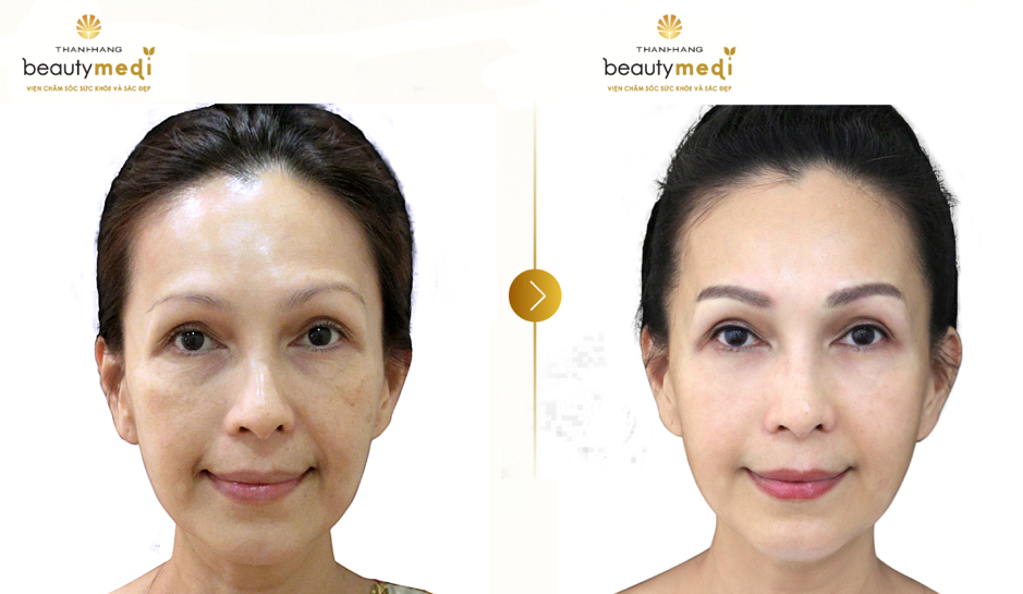 Diễn viên Diễm my trước và sau khi phun thêu môi Hàn Quốc tại Thanh Hằng Beauty Medi