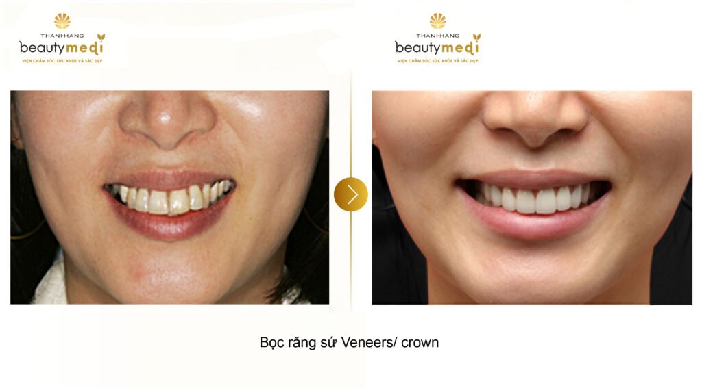 Hình ảnh thực tế của khách hàng trước và sau khi sử dụng dịch vụ bọc răng sứ Crown tại Thanh Hằng Beauty Medi
