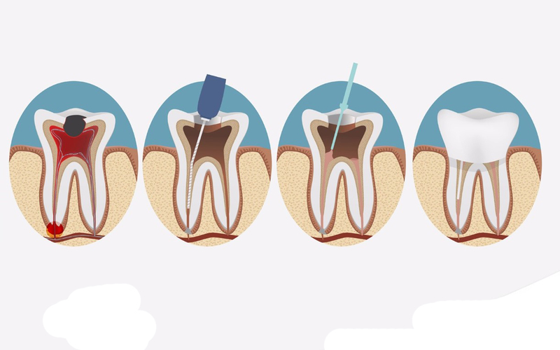 Bọc răng sứ sẽ cần lấy tủy răng khi răng bị sâu