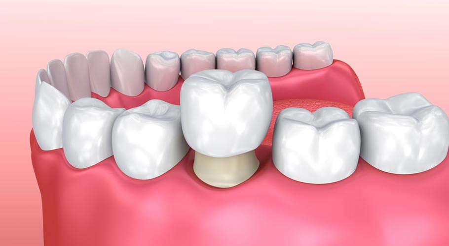 Bọc răng sứ có thể tháo ra nếu răng sứ đang bọc ảnh hưởng chức năng nhai