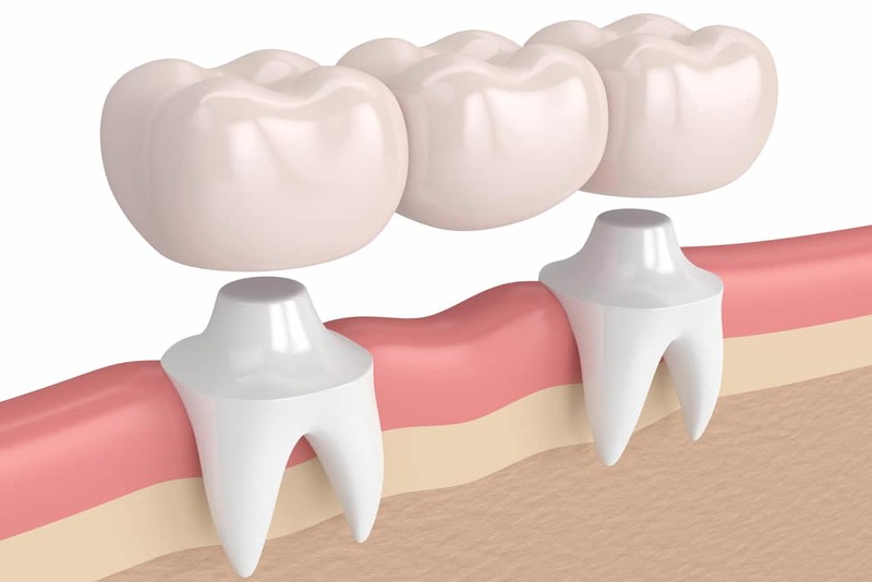 Răng sứ và nướu không khớp thì cần tháo ra và học lại