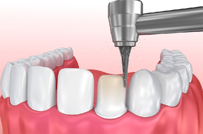 Nha sĩ sẽ mài nhỏ mão sứ để tiếp cận khung sườn mão răng