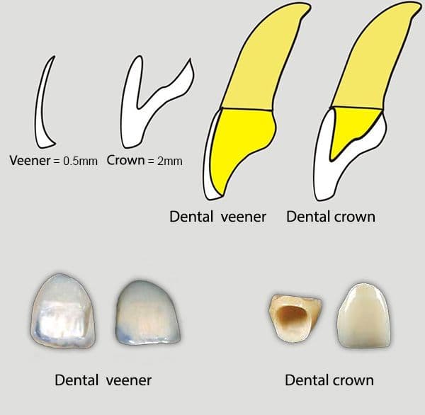 Dán răng sứ Veneer mỏng, bền và đẹp