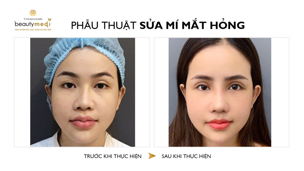 Hình ảnh trước và sau của khách hàng khi phẫu thuật mắt tại Thanh Hằng Beauty Medi