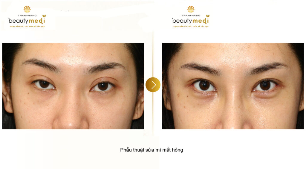 Hình ảnh trước và sau của khách hàng khi phẫu thuật mắt tại Thanh Hằng Beauty Medi