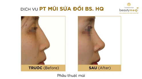 Mũi bị đỏ sau khi nâng 2