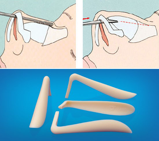 Sử dụng sụn nâng mũi kém chất lượng có thể khiến mũi bị đỏ sau khi nâng 