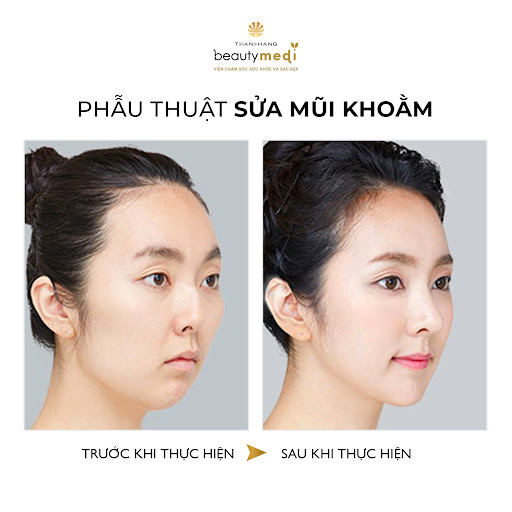 Hình ảnh trước và sau khi phẫu thuật mũi tại Thanh Hằng Beauty