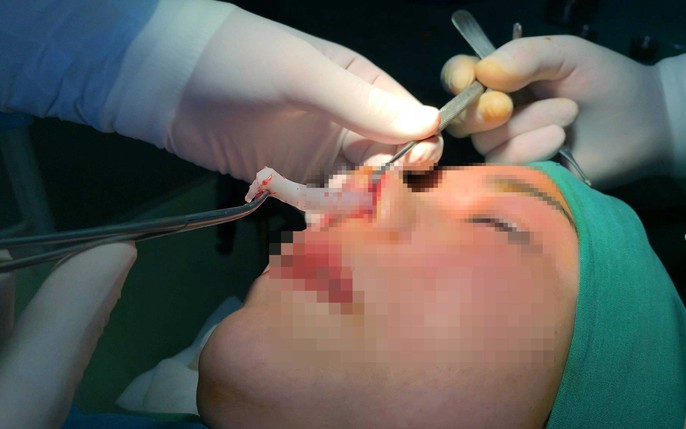 Sụn nâng mũi kém chất lượng, không tương thích với cơ địa sẽ dễ bị tụt sau phẫu thuật